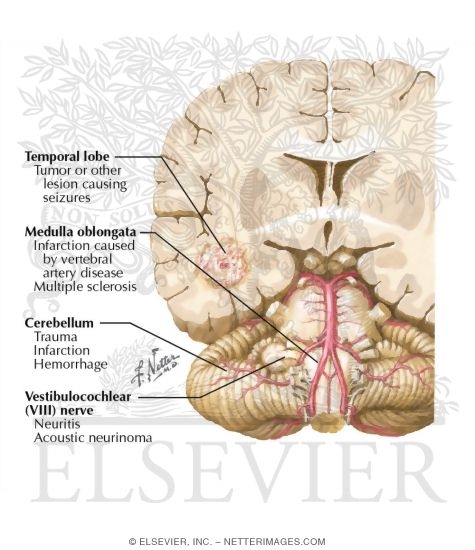 Watermarked preview of labeled image: Causes of Vertigo