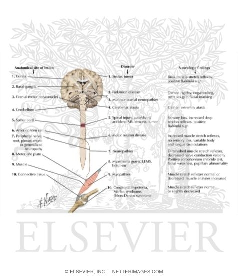 Watermarked preview of labeled image: Hypotonia