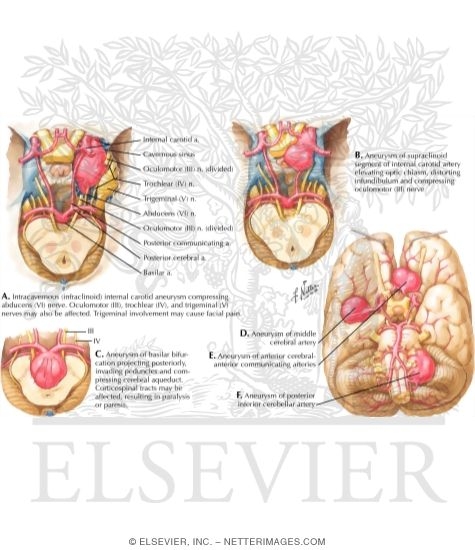 Giant Congenital Aneurysms