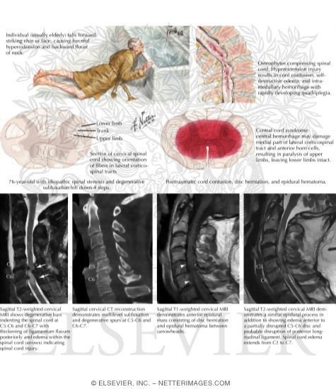 Watermarked preview of labeled image: Paralysis Without Vertebral Injury