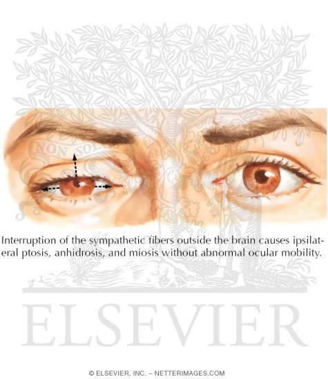 Horner's Syndrome