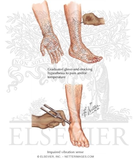 Watermarked preview of labeled image: Documentation of Various Types of Sensory Modalities In a Peripheral Neuropathy