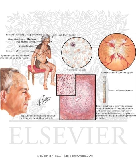 Giant-Cell (Temporal) Arteritis, Polymyalgia Rheumatica