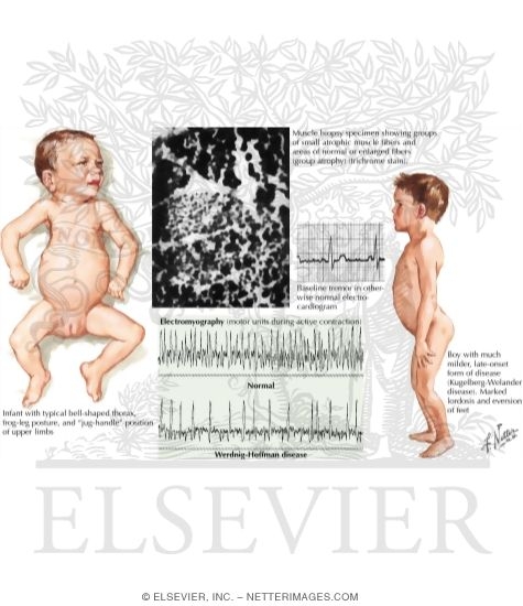 Watermarked preview of labeled image: Werdnig-Hoffmann Disease