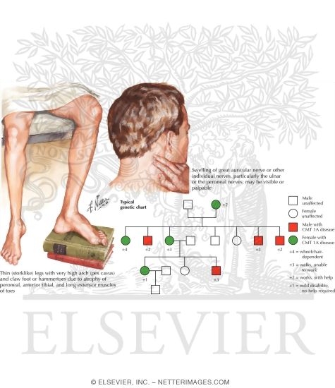 Hereditary Motor-Sensory Neuropathy Type I