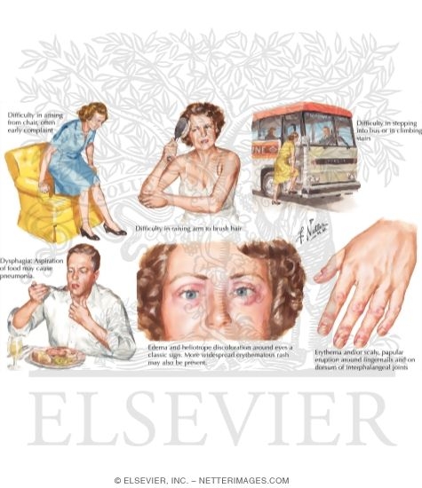 Polymyositis and Dermatomyositis
