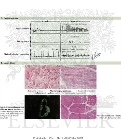 Polymyositis and Dermatomyositis