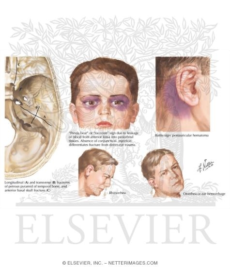Basilar Skull Fractures