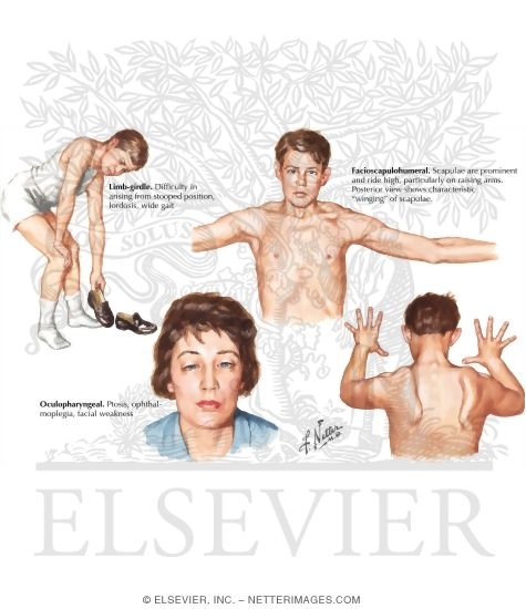 Watermarked preview of labeled image: Other Types of Muscular Dystrophy