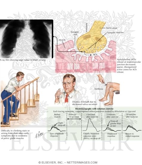 Lambert-Eaton Syndrome