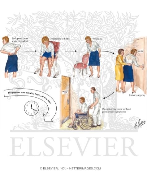 Watermarked preview of labeled image: Acute Spinal Cord Syndromes: Evolution of Symptoms
