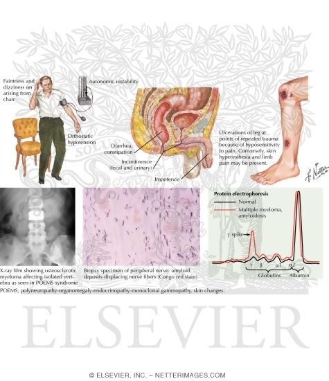 Dysproteinemia (Amyloid Neuropathy)