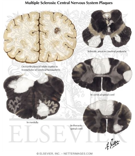 Multiple Sclerosis: Central Nervous System Pathology