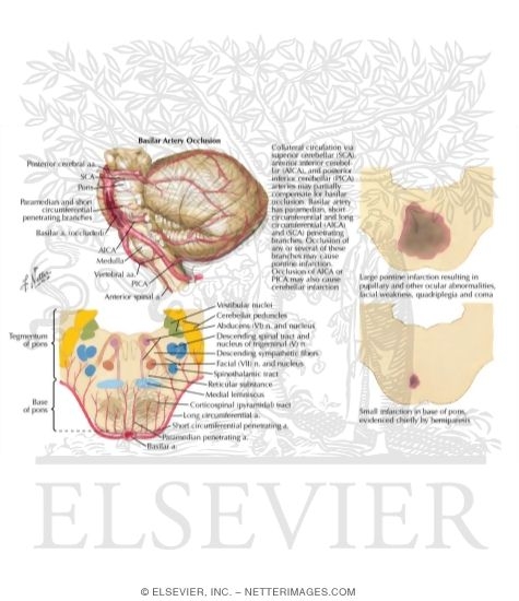 Watermarked preview of labeled image: Occlusion of Basilar Artery and Branches