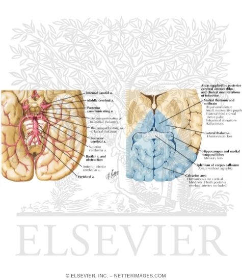 Occlusion of Top of Basilar and Posterior Cerebral Arteries