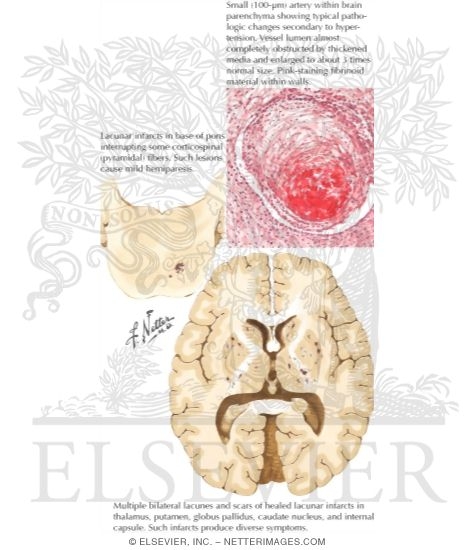 Watermarked preview of labeled image: Lacunar Infarction