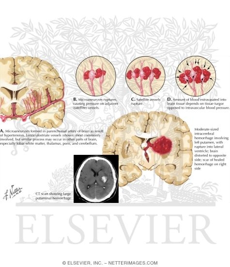Intracerebral Hemorrhage (Hypertensive): Pathogenesis