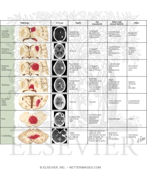 Intracerebral Hemorrhage: Clinical Manifestations Related to Site