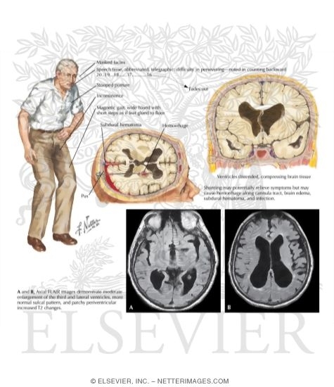 Normal Pressure Hydrocephalus