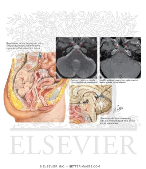 Watermarked preview of labeled image: Chordomas