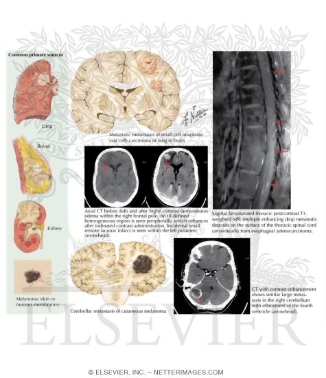Tumors Metastatic to Brain