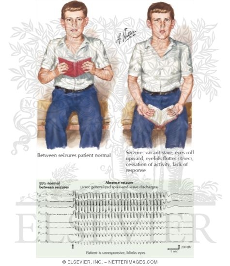 Absence (Petit Mal) Seizures