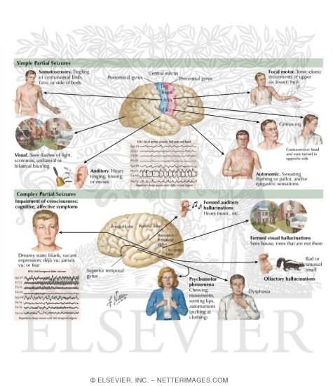 Simple Partial Seizures
