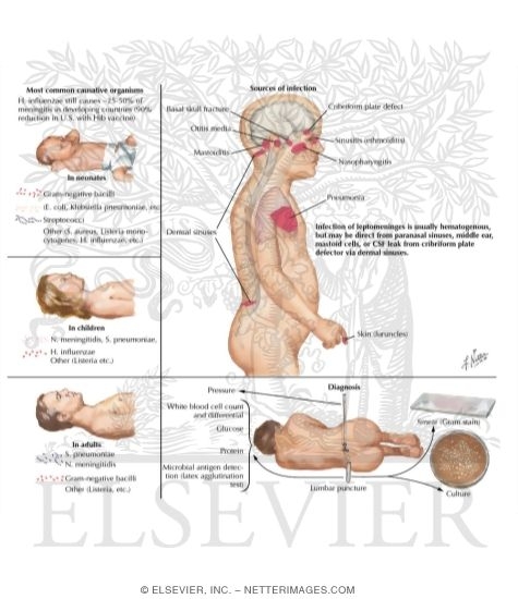 Watermarked preview of labeled image: Bacterial Meningitis