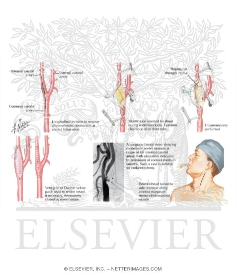 Watermarked preview of labeled image: Endarterectomy for Extracranial of Carotid Artery Atherosclerosis