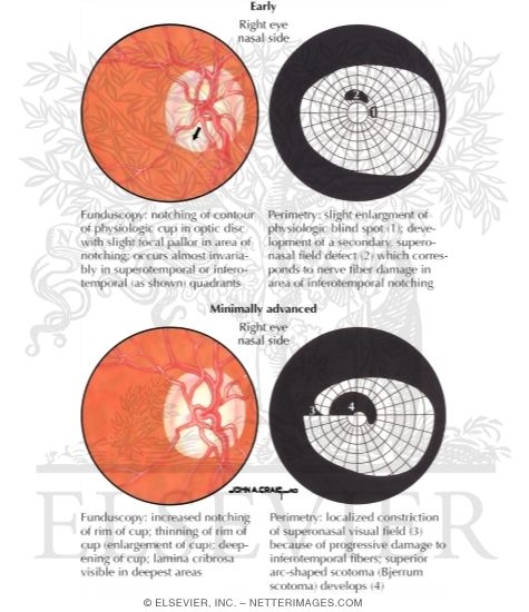 Optic Disc and Visual Field Changes In Glaucoma