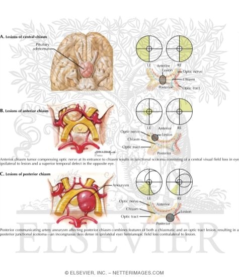 Disorders Affecting Optic Chiasm