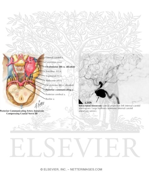 Posterior Communicating Artery Aneurysm Compressing Cranial Nerve III