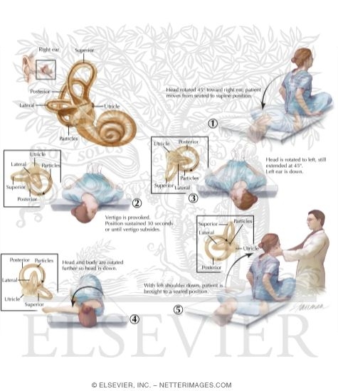Canalith Repositioning Epley Maneuver