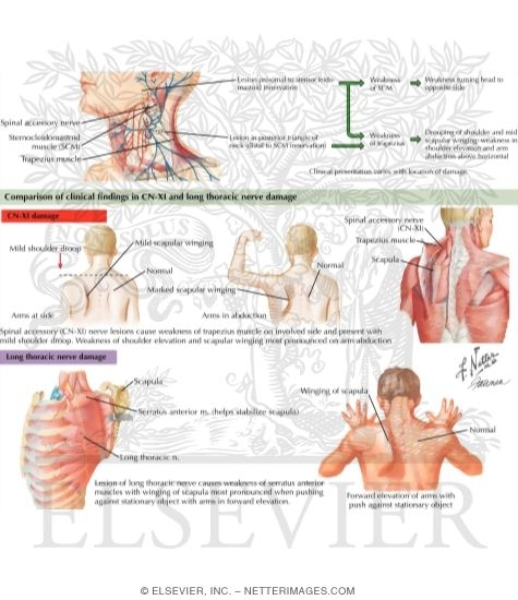 Watermarked preview of labeled image: Clinical Findings In Cranial Nerve XI Damage
