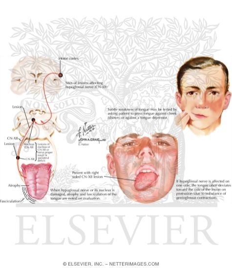 Hypoglossal Nerve (CN-XII)