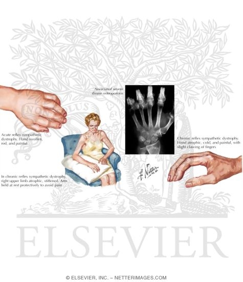 Watermarked preview of labeled image: Reflex Sympathetic Dystrophy
