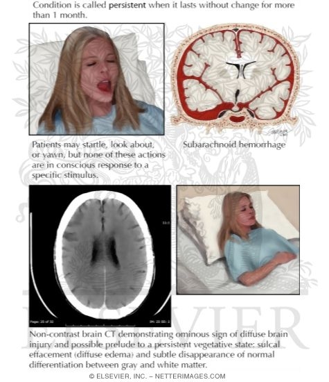 Persistent Vegetative State