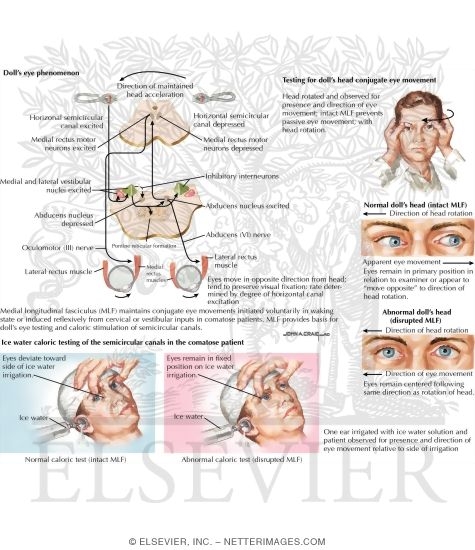 Eye Movements With Increased ICP