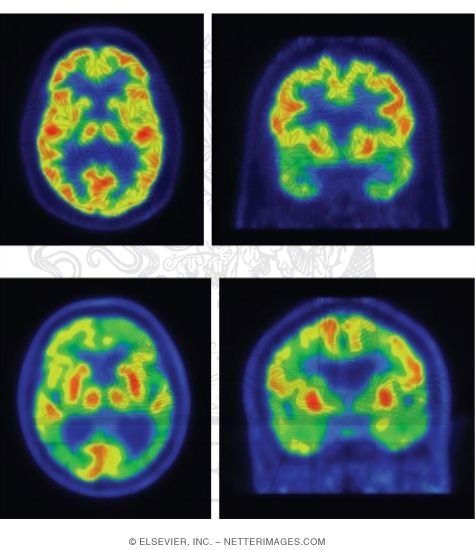 FDG-PET Typical Pattern for Alzheimer Disease