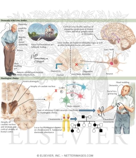 Dementia With Lewy Bodies