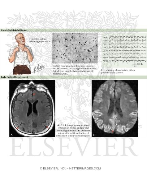 Transmissible Spongiform Encephalopathy