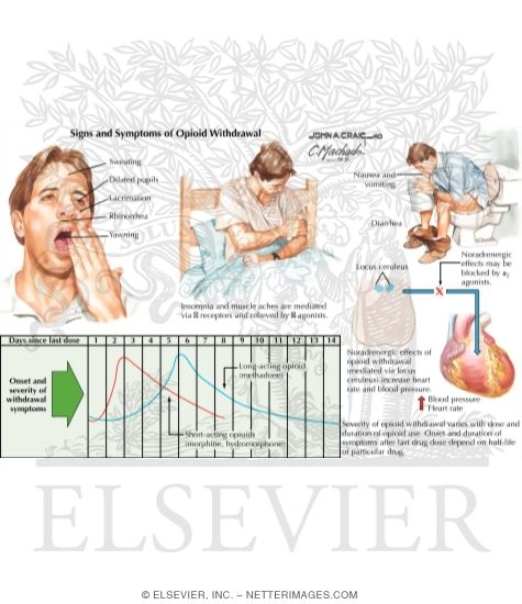Watermarked preview of labeled image: Opioid Withdrawal