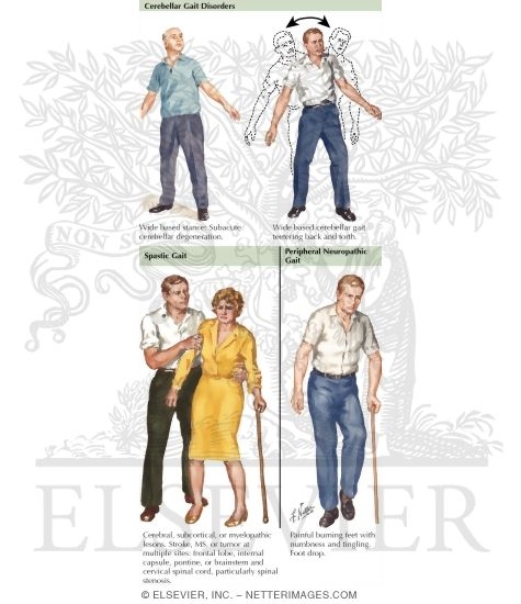 Neuropathic Gait Disorders