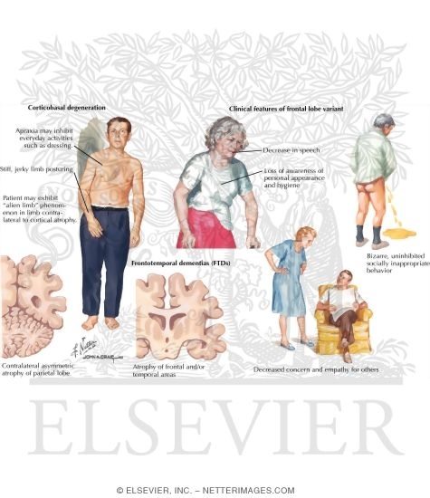 Other Tauopathies. Corticobasal Degeneration and Frontotemporal Dementia