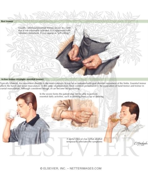 Watermarked preview of labeled image: Tremor