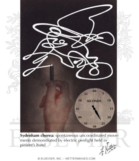 Rheumatic Fever; Sydenham's Chorea