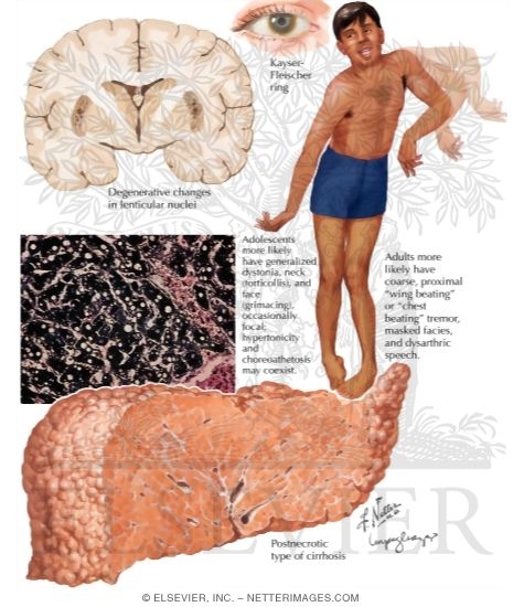 Wilson Disease