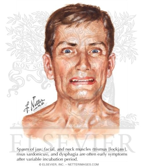 Acute Dystonic Reaction