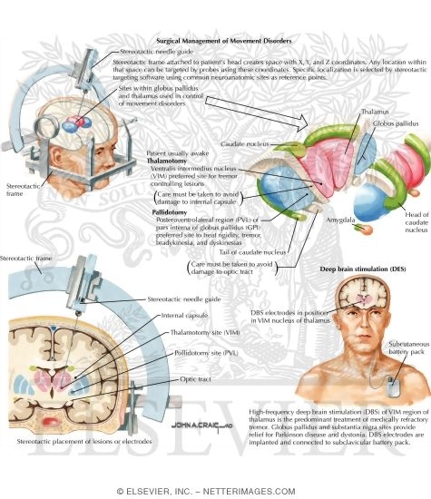 Watermarked preview of labeled image: Surgical Management of Movement Disorders
