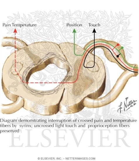 Syringomyelia
